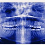 The Horrors of TMJ: Chronic Pain, Metal Jaws, and Futile Treatments