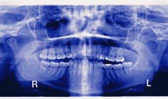 The Horrors of TMJ: Chronic Pain, Metal Jaws, and Futile Treatments
