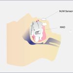 A Promising New Method to Titrate Oral Appliances