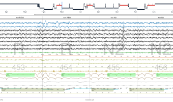 How Software Can Simplify Hypopnea Scoring for Varied Payors