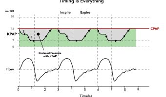 Investigational Lower-Pressure CPAP as Effective as Traditional CPAP, Study Finds 