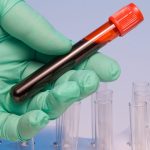 Blood Sample Timing Affects Dementia Diagnostic Results