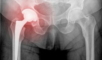 CPAP Reduces Complications in Hip and Knee Replacement Surgery in People with OSA